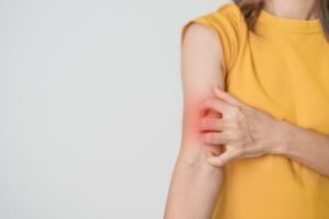 4 Faktor Penyebab Lupus yang Perlu Diketahui