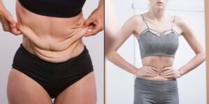 Kencangkan Kulit Setelah Turun Berat Badan