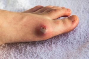 Penyebab Luka Kaki Susah Sembuh pada Pasien Diabetes